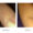 Case of Chronic Urticaria