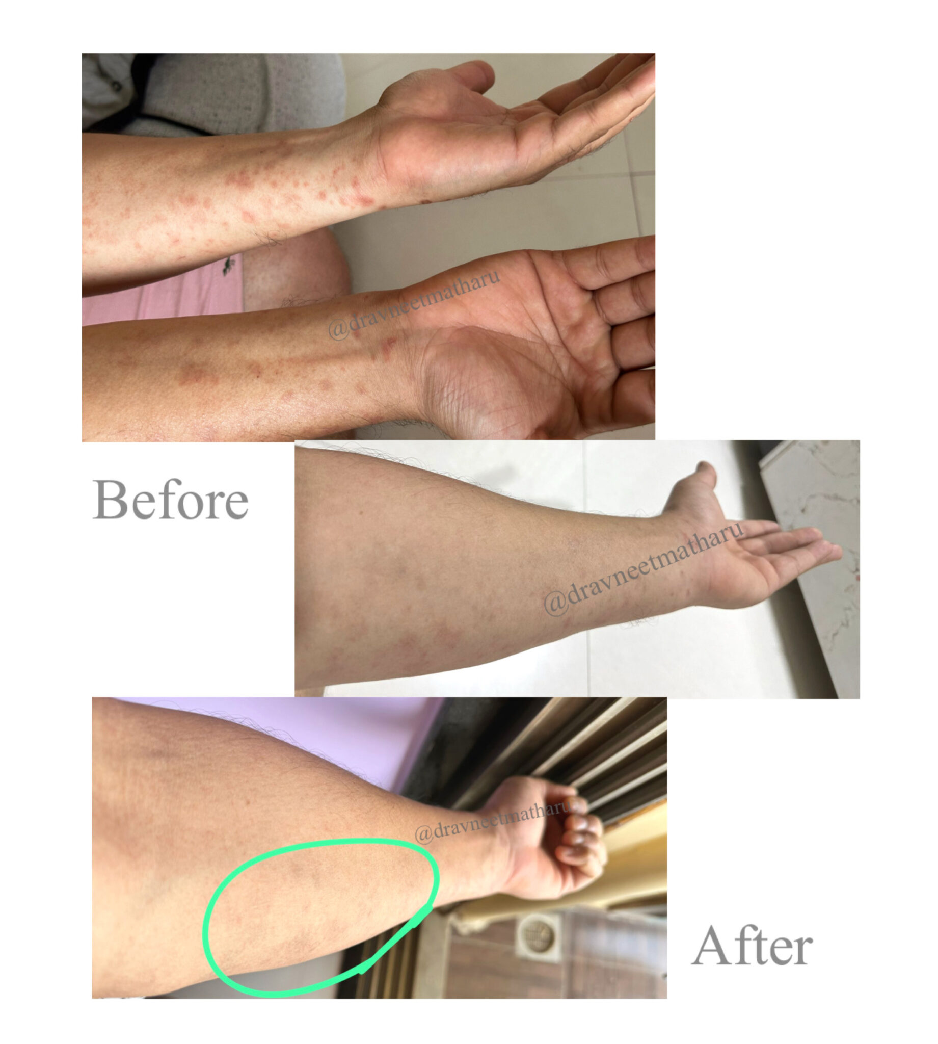 Case of Lichen Planus